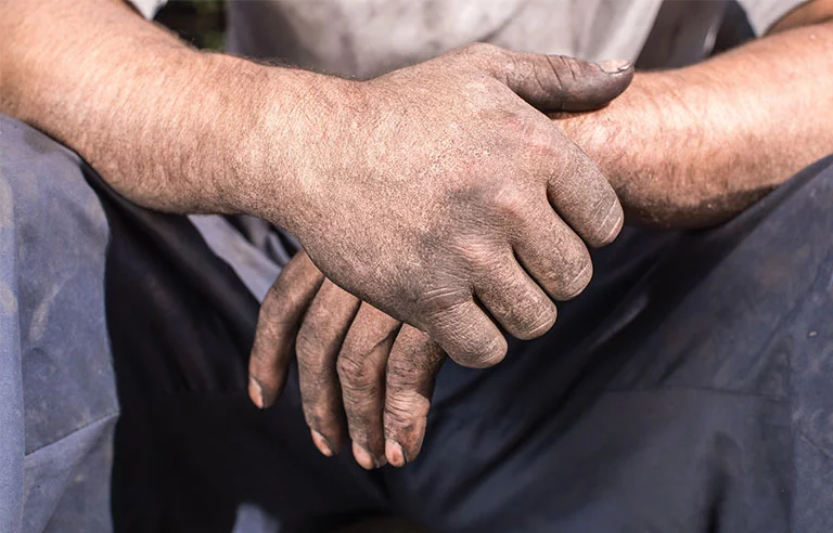 Occupational skin disorders