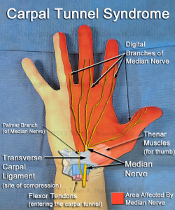 9 Tips to Prevent Carpal Tunnel Syndrome - HSSE WORLD