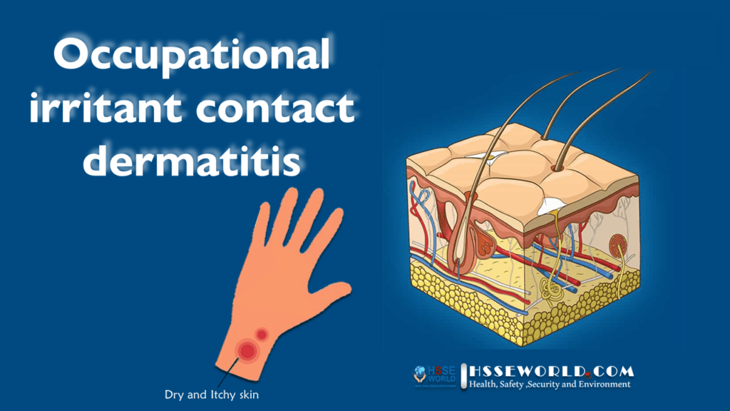 Occupational Contact Dermatitis