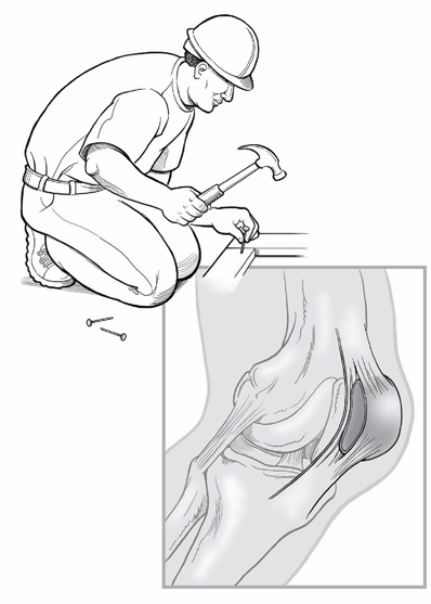 Protect knee- Knee pain