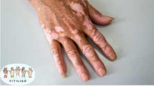 Vitiligo